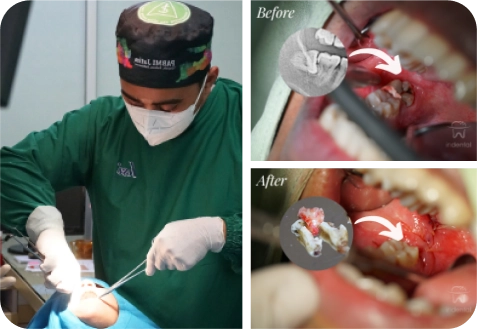 proses cabut gigi geraham
