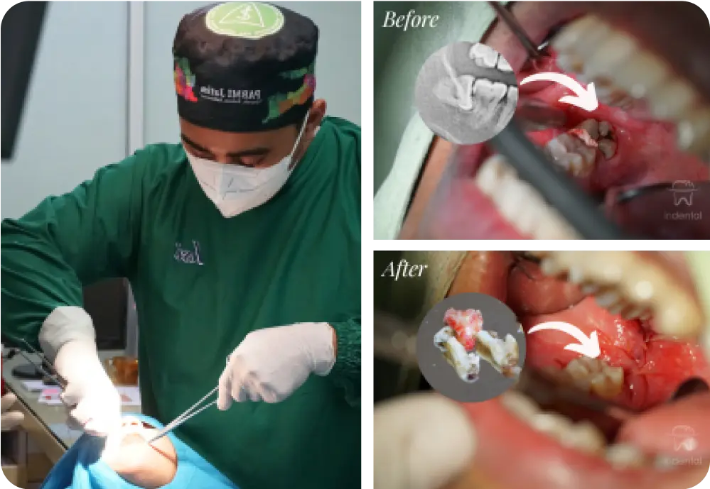 proses cabut gigi geraham