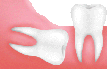proses odontektomi